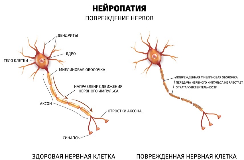 Невропатия аксонального типа. Периферическая сенсорная нейропатия. Нейропатия периферических нервов. Диабетическая периферическая нейропатия. Этиология полинейропатии.